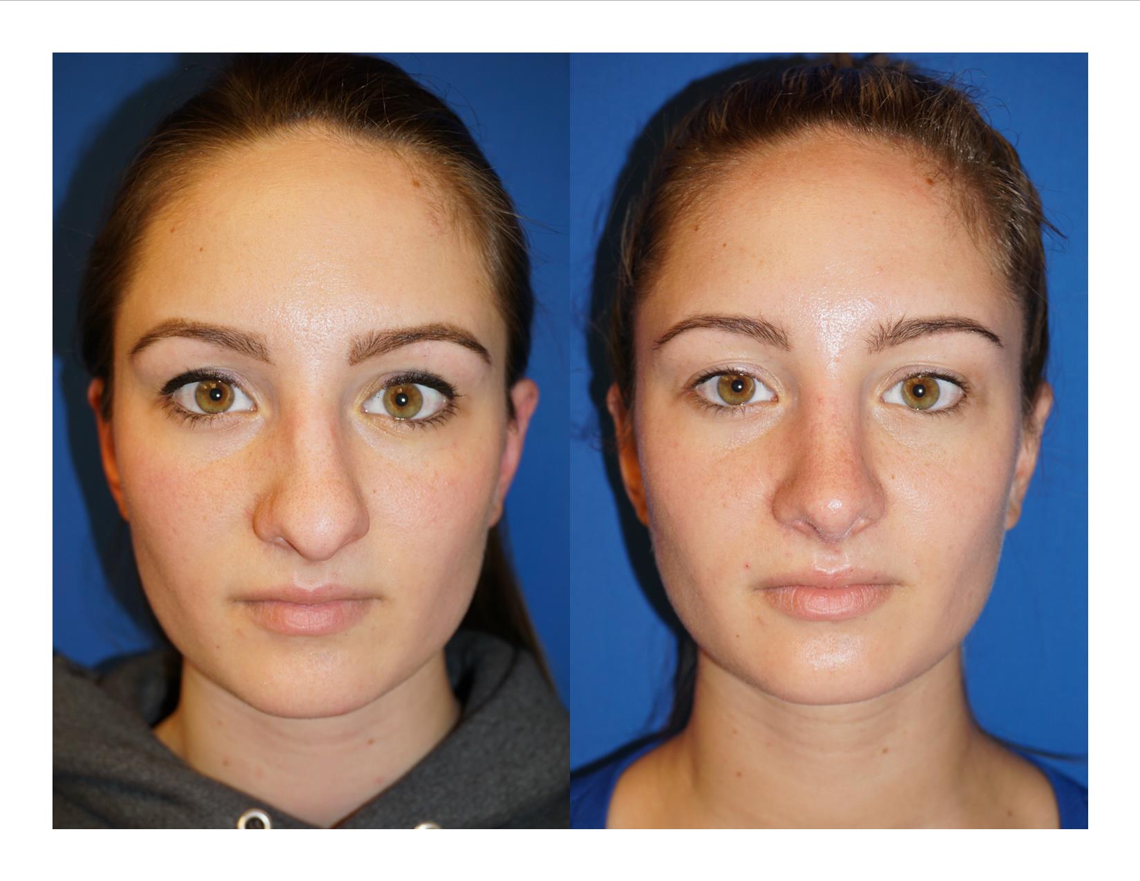 Rhinoplasty 1 Image 1