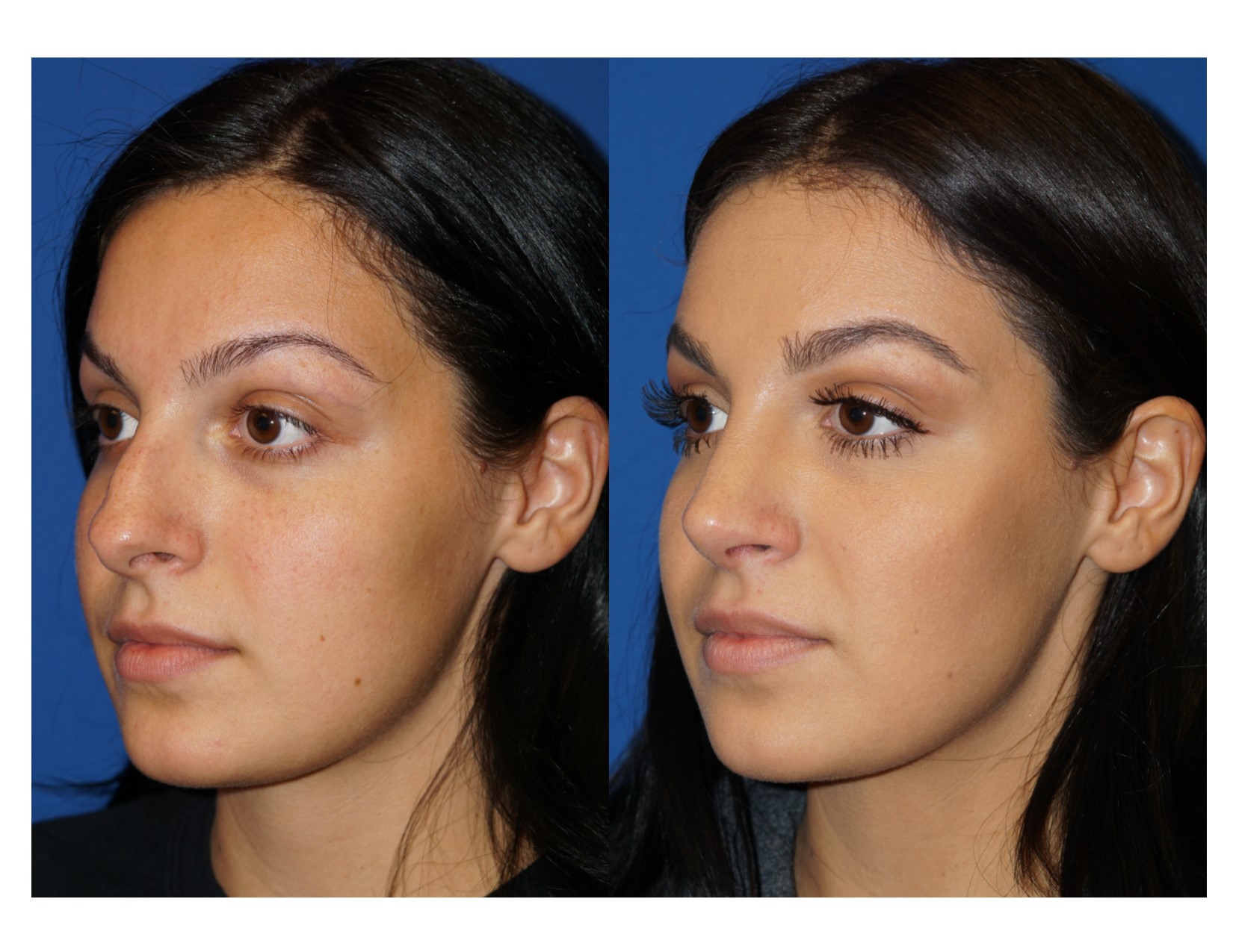 Rhinoplasty 6 Image 2 