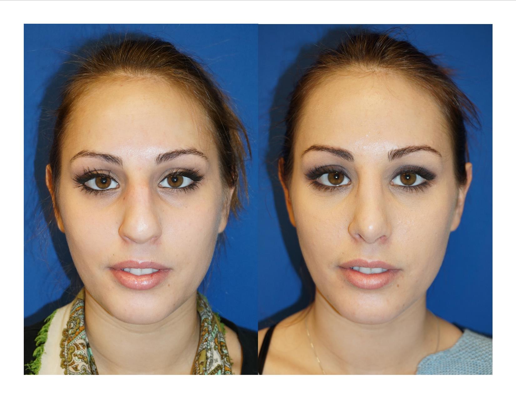Rhinoplasty 12 Image 3