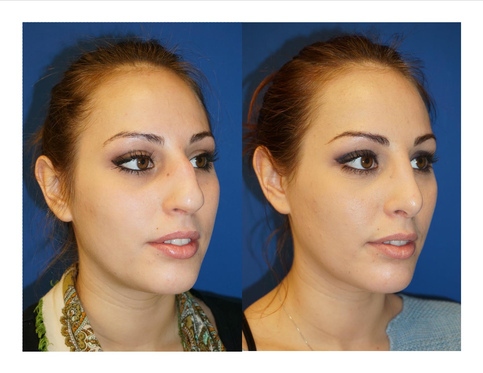Rhinoplasty 12 Image 4