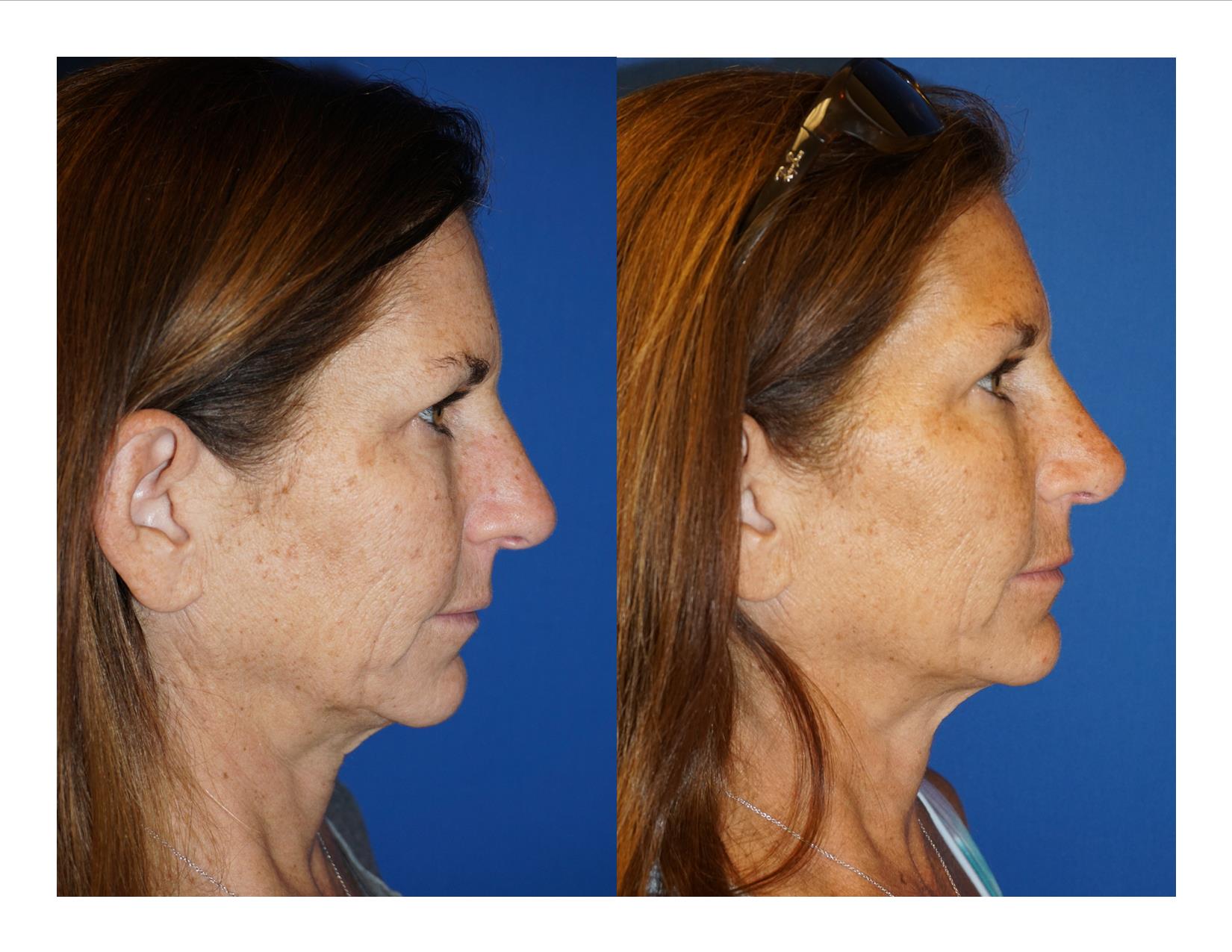 Rhinoplasty 7 Image 3