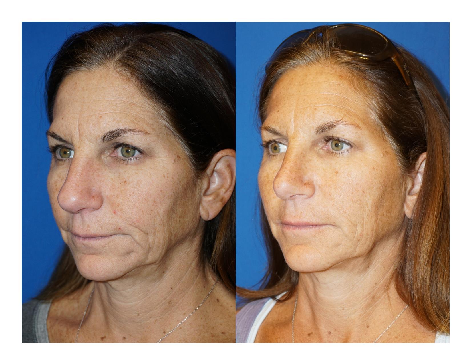 Rhinoplasty 7 Image 4