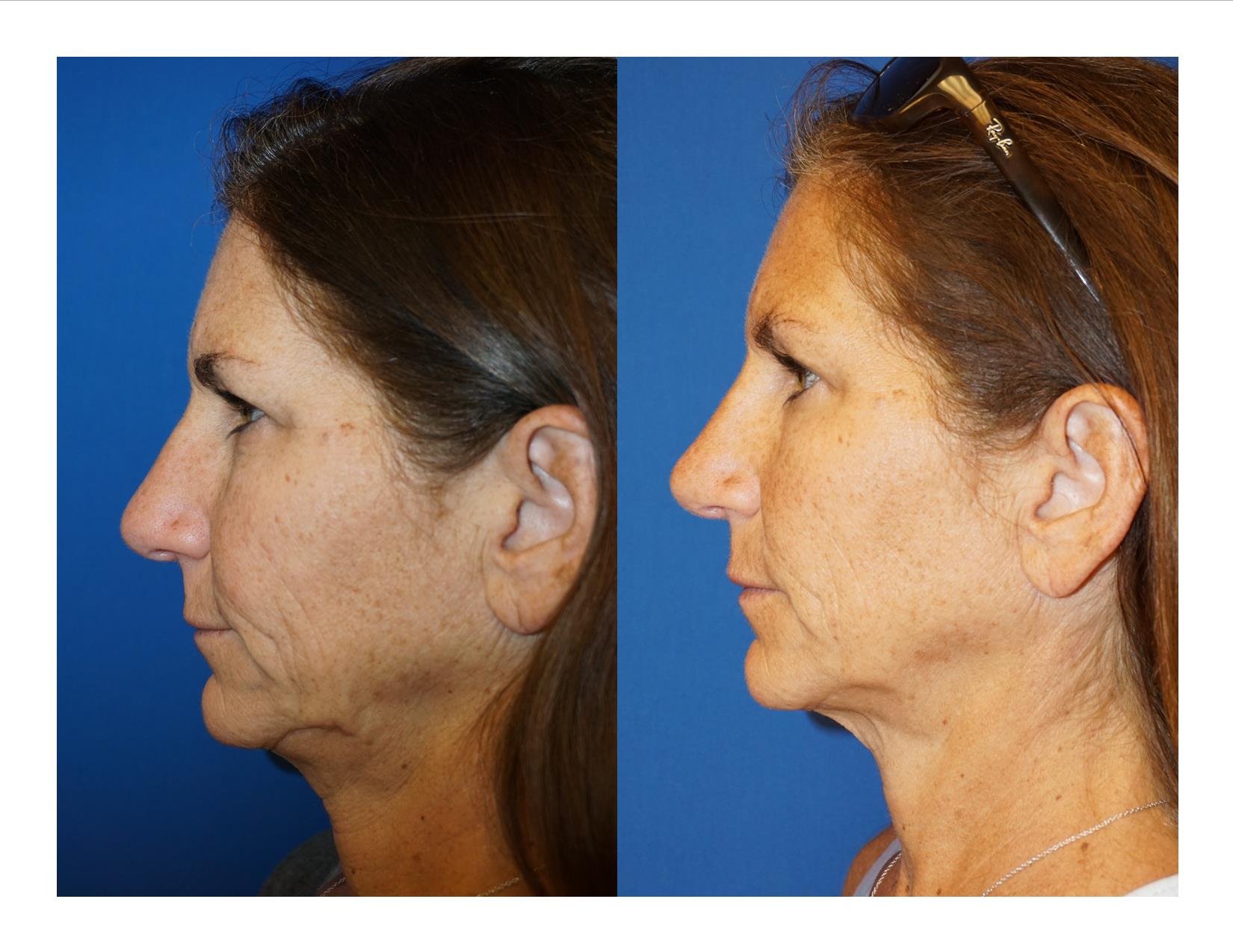 Rhinoplasty 7 Image 5