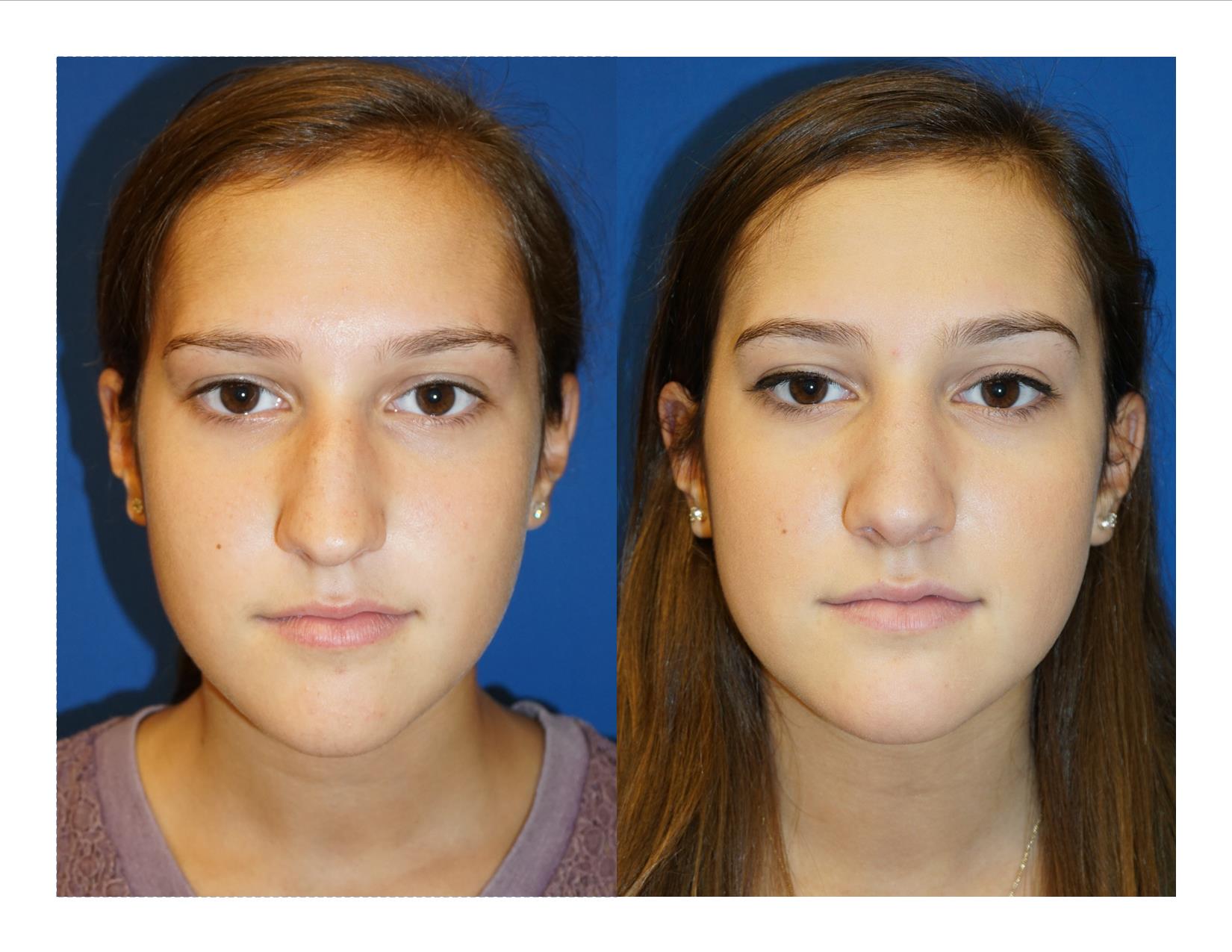 Rhinoplasty 9 Image 3