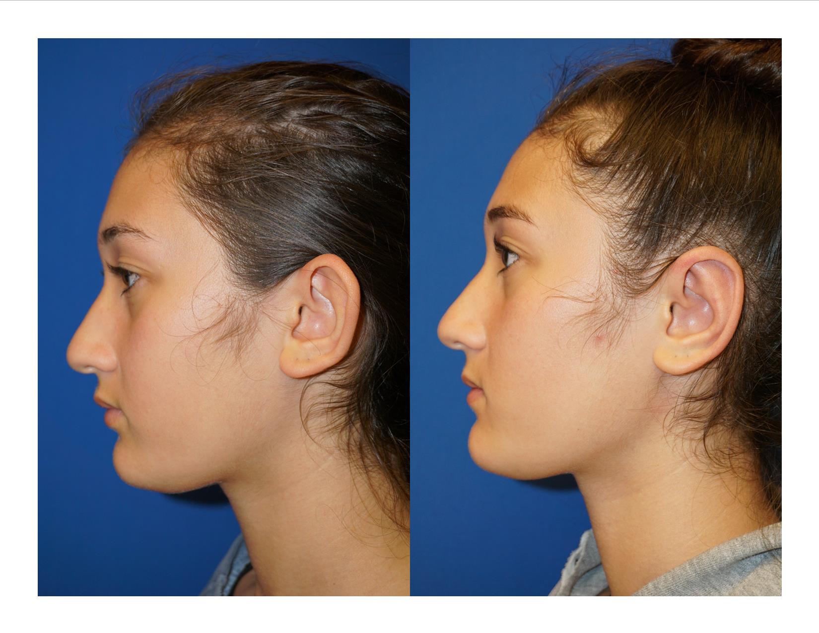 Otoplasty 2 Image 3