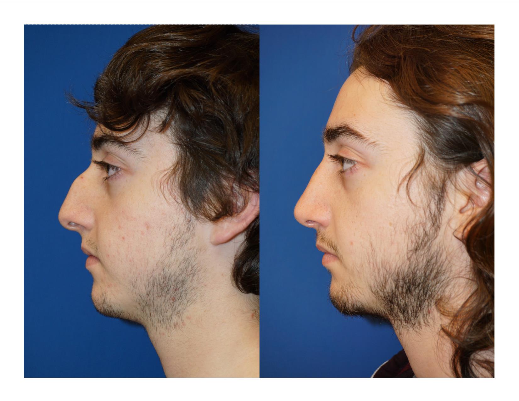 Rhinoplasty 8 Image 3
