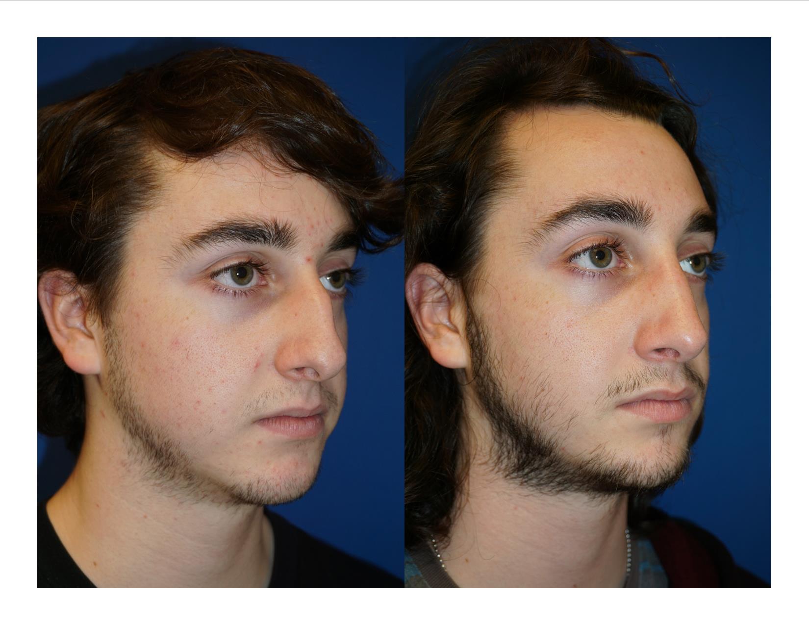 Rhinoplasty 8 Image 4