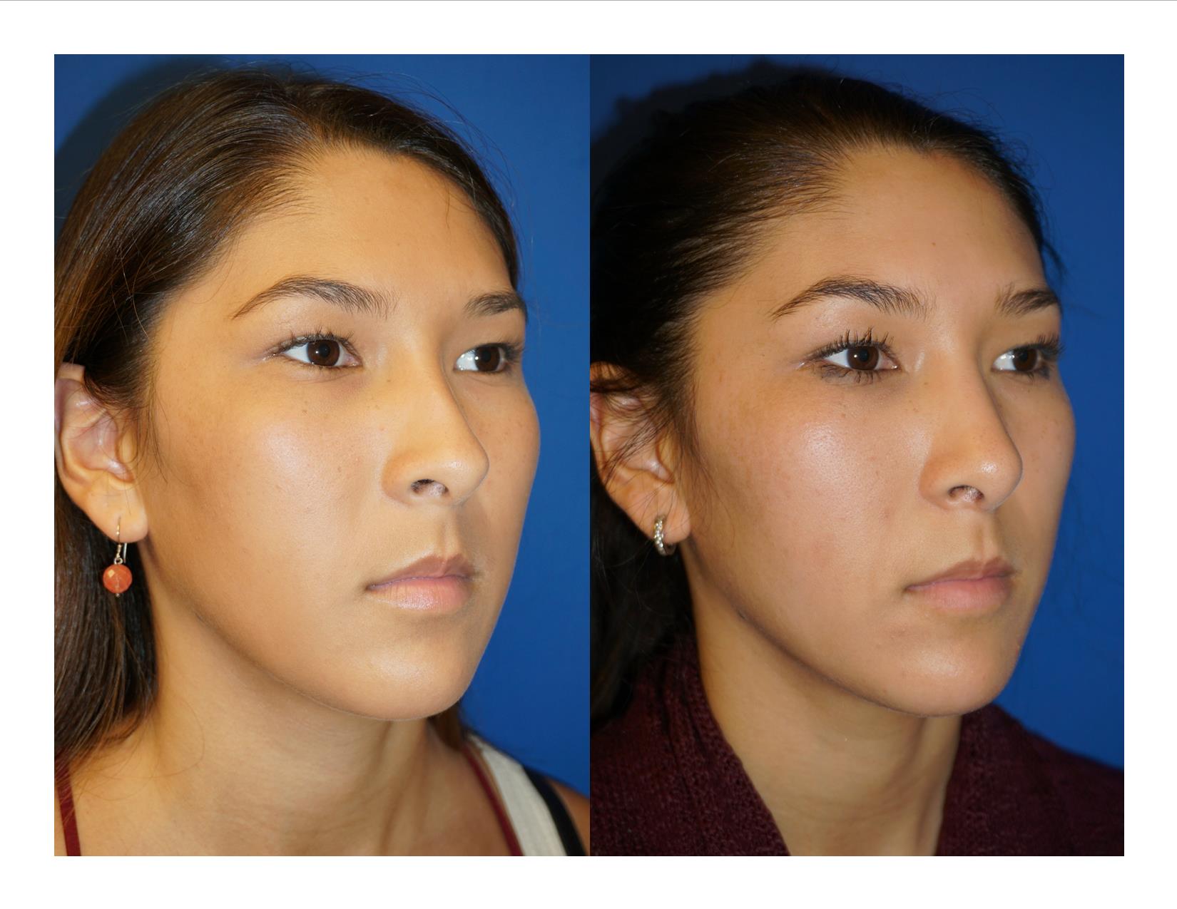 Rhinoplasty 11 Image 2