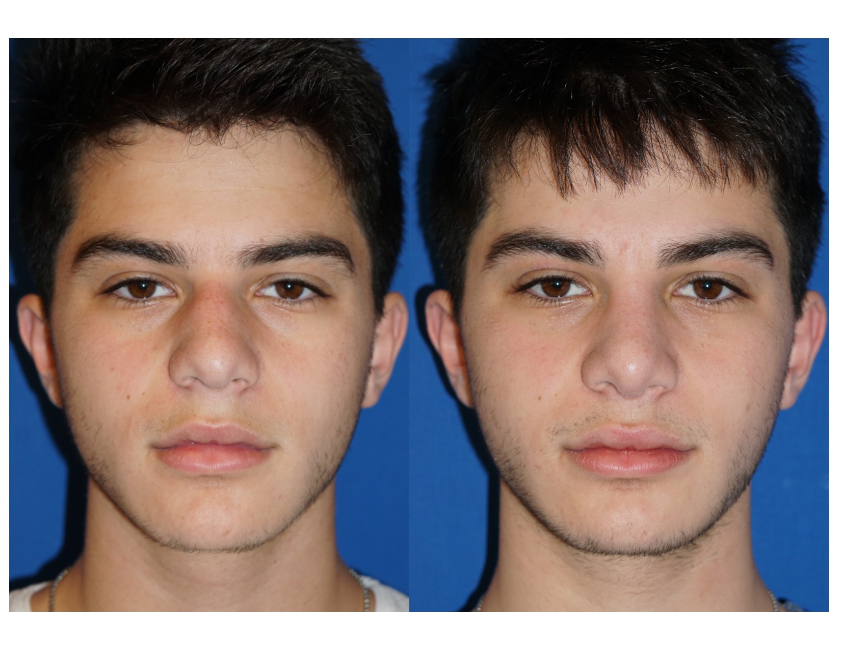 Rhinoplasty 10 Image 3
