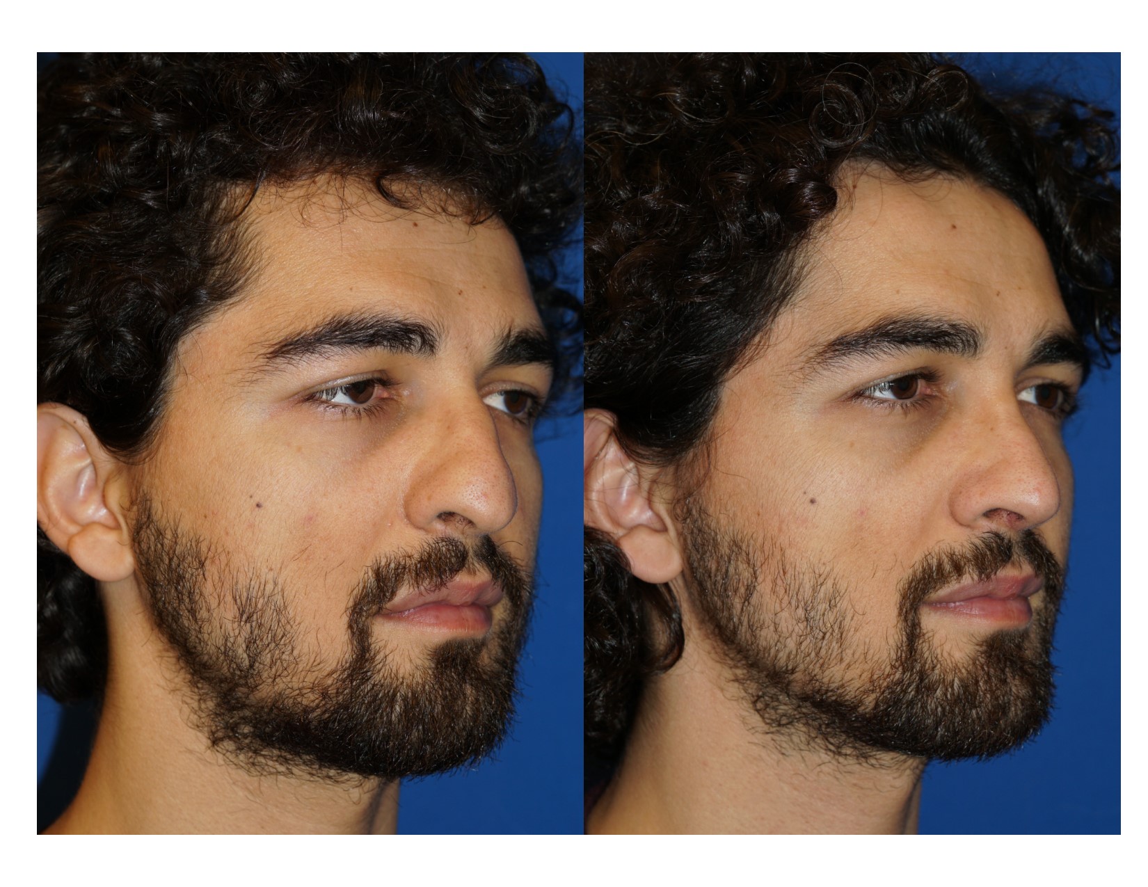 Rhinoplasty 13 Image 4