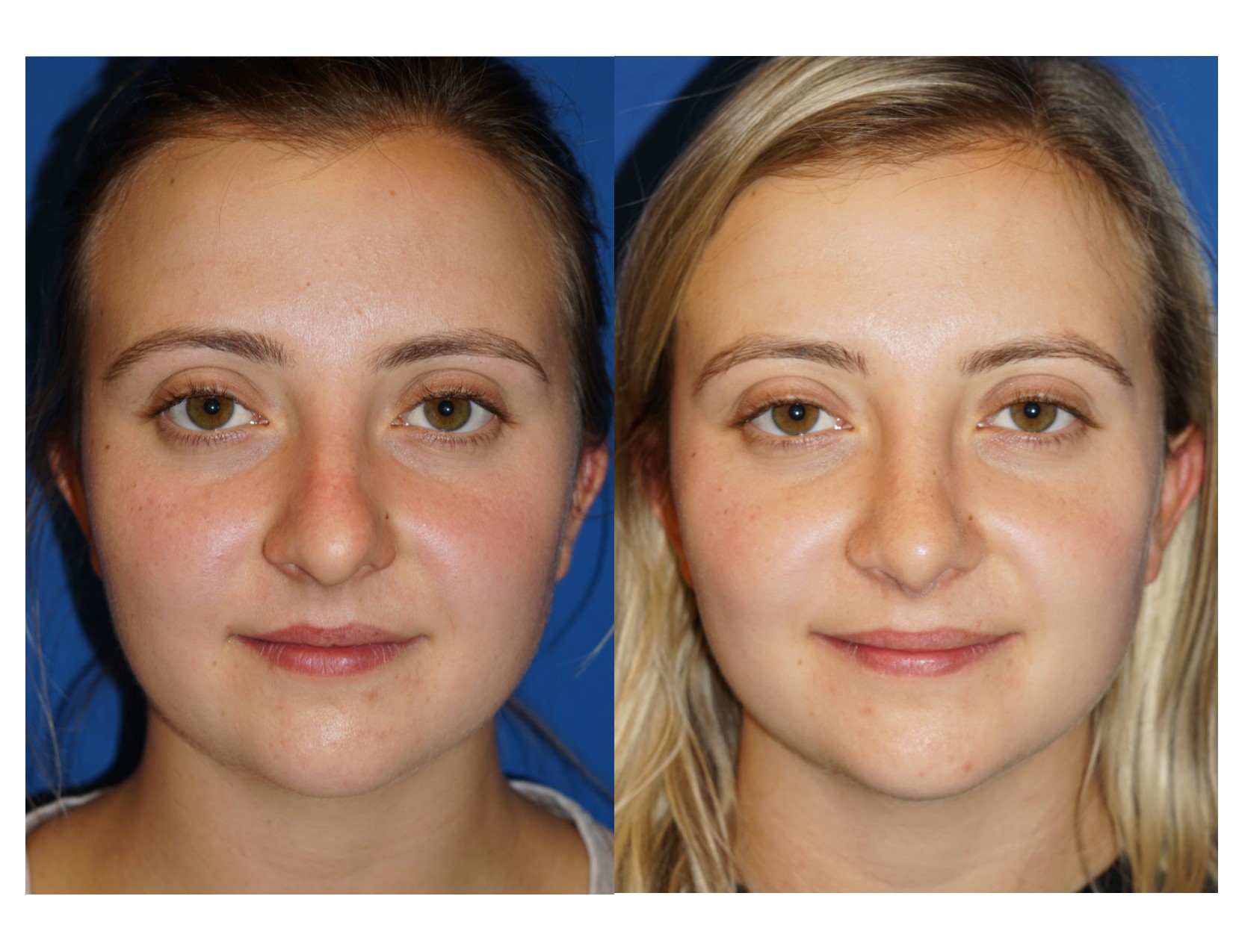 Rhinoplasty 15 Image 3