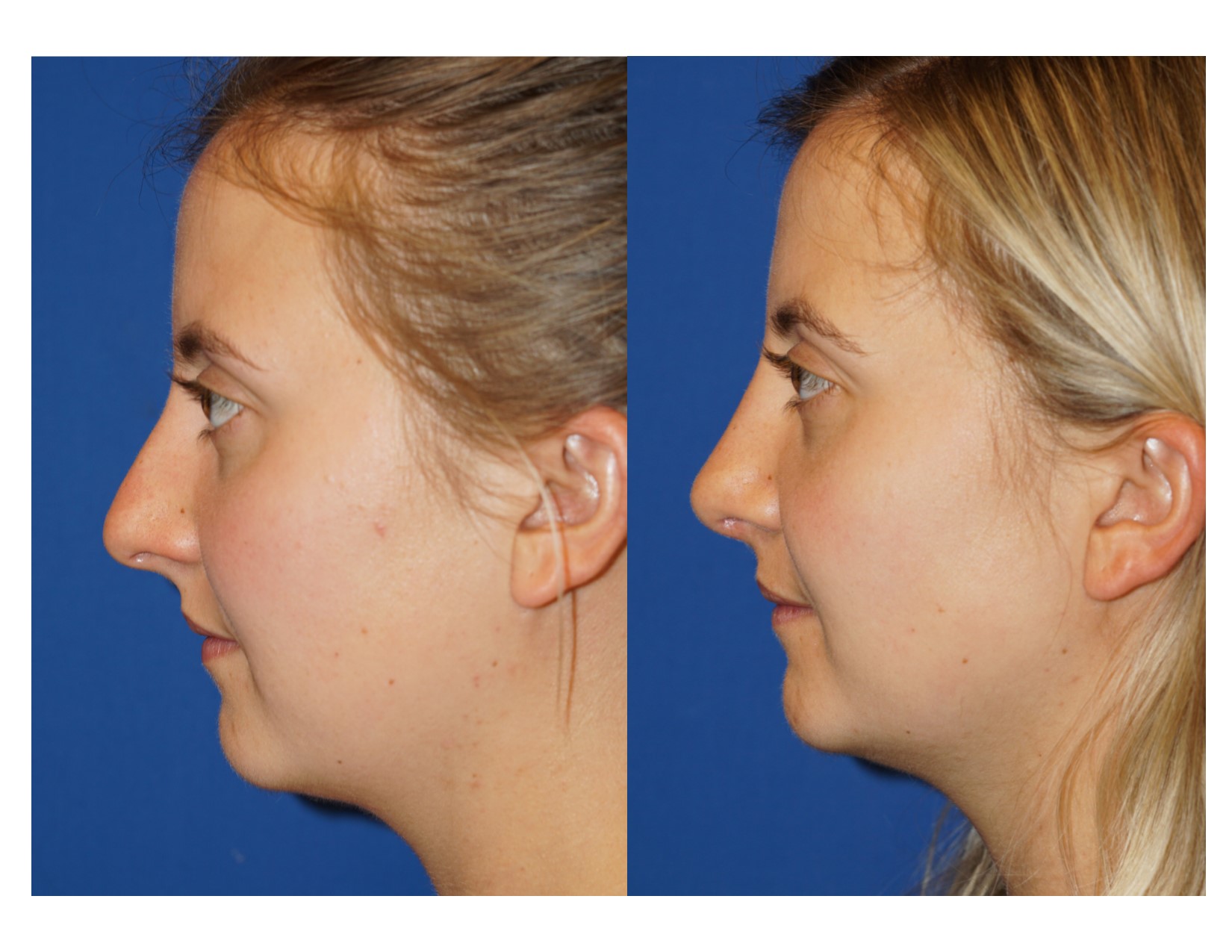 Rhinoplasty 15 Image 5