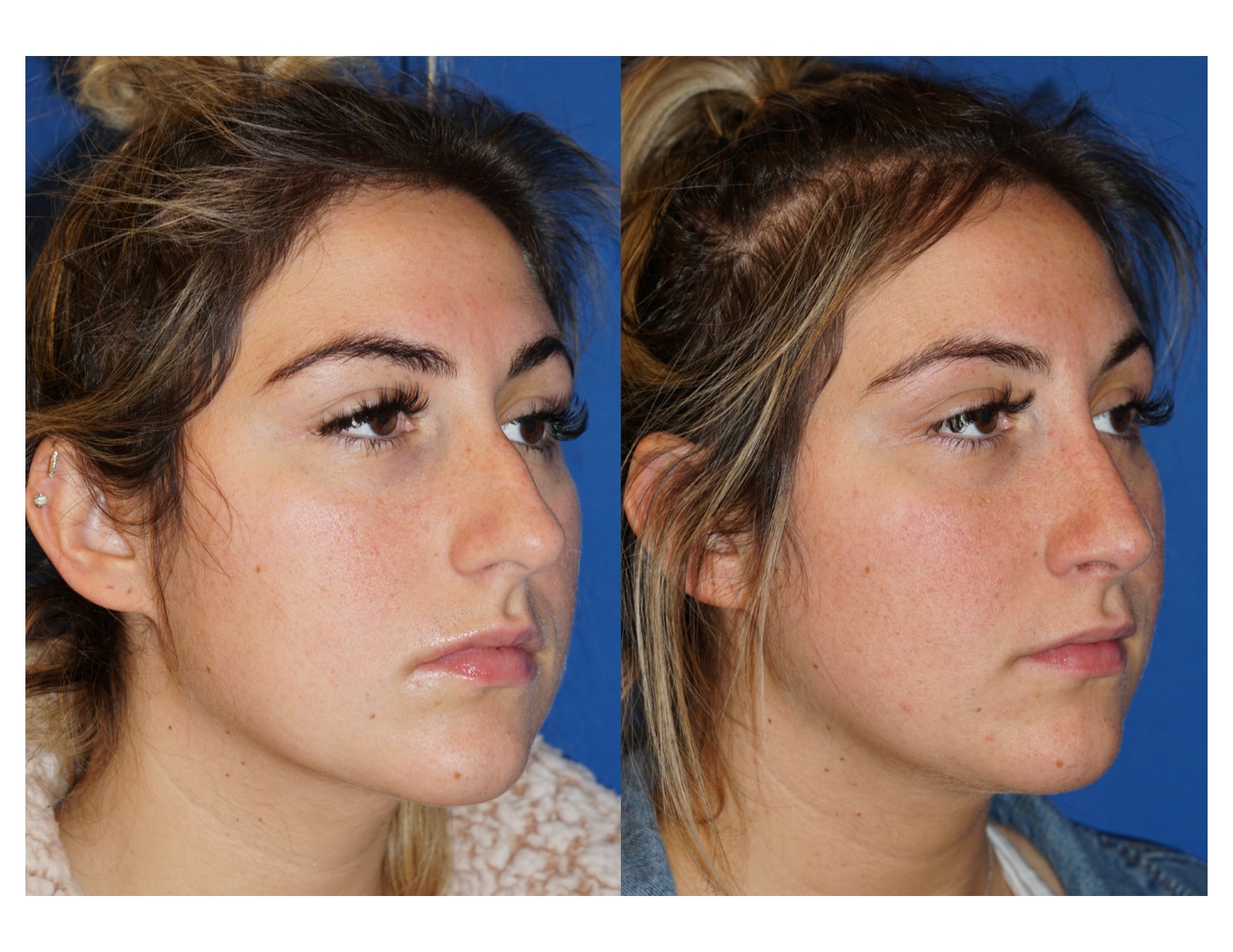 rhinoplasty3_2