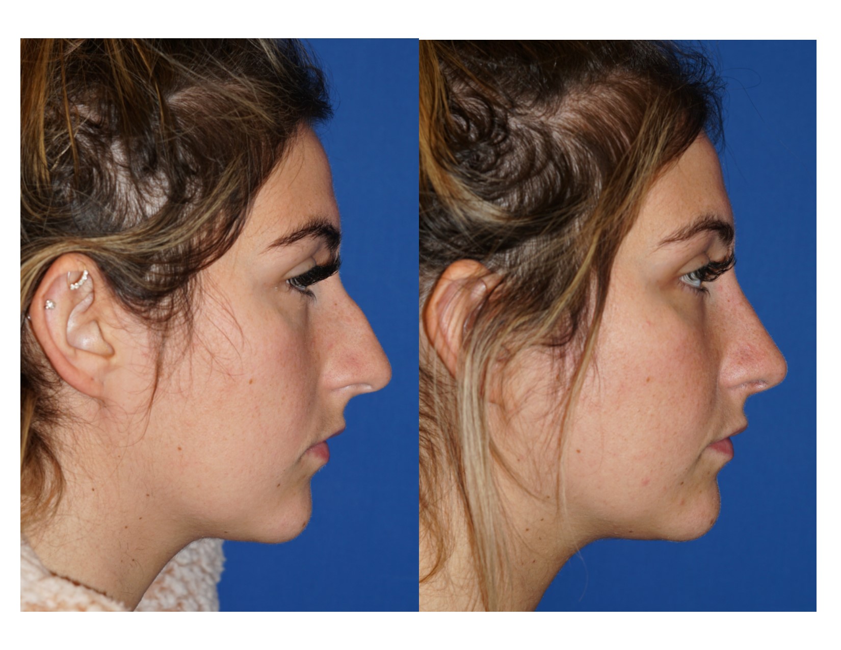 rhinoplasty3_4