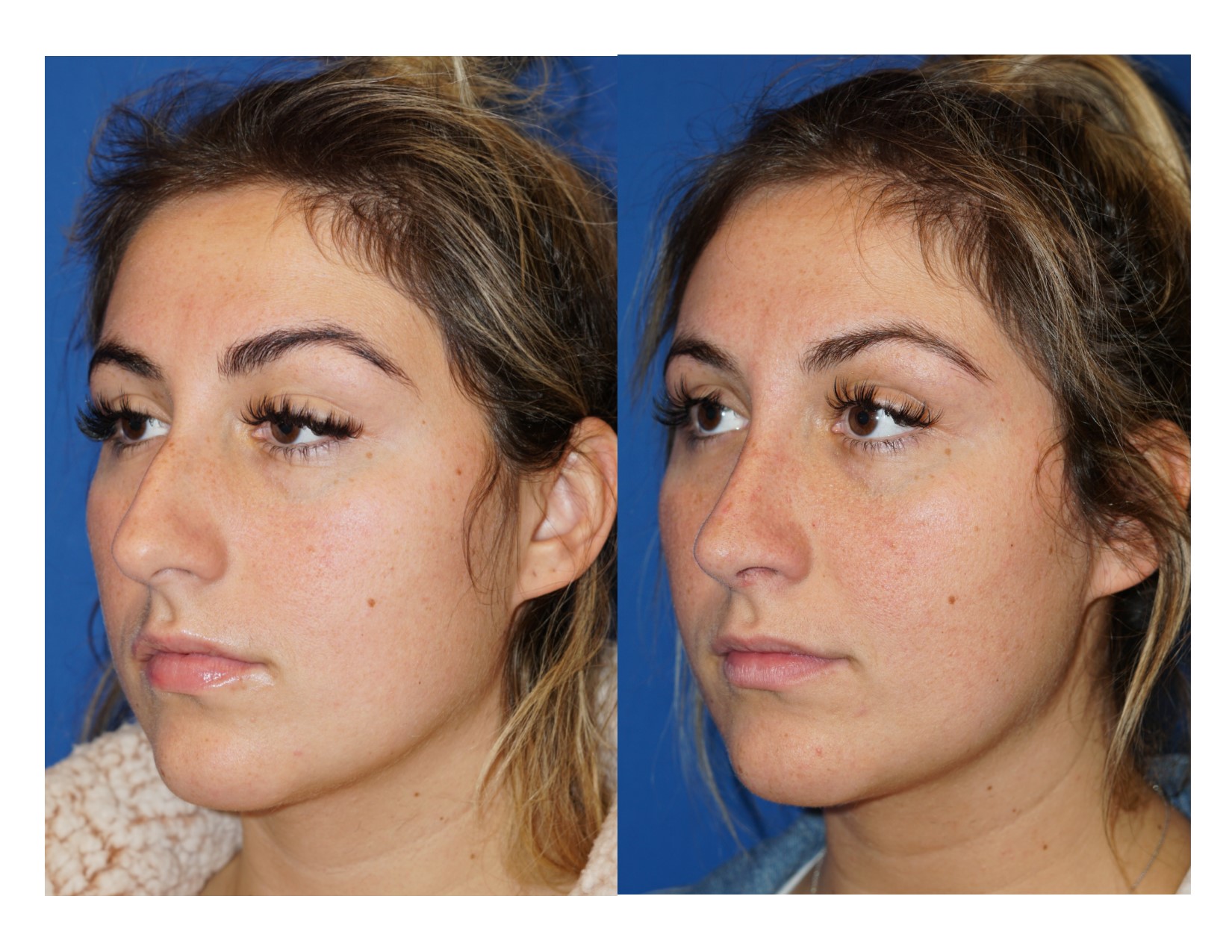 rhinoplasty3_5