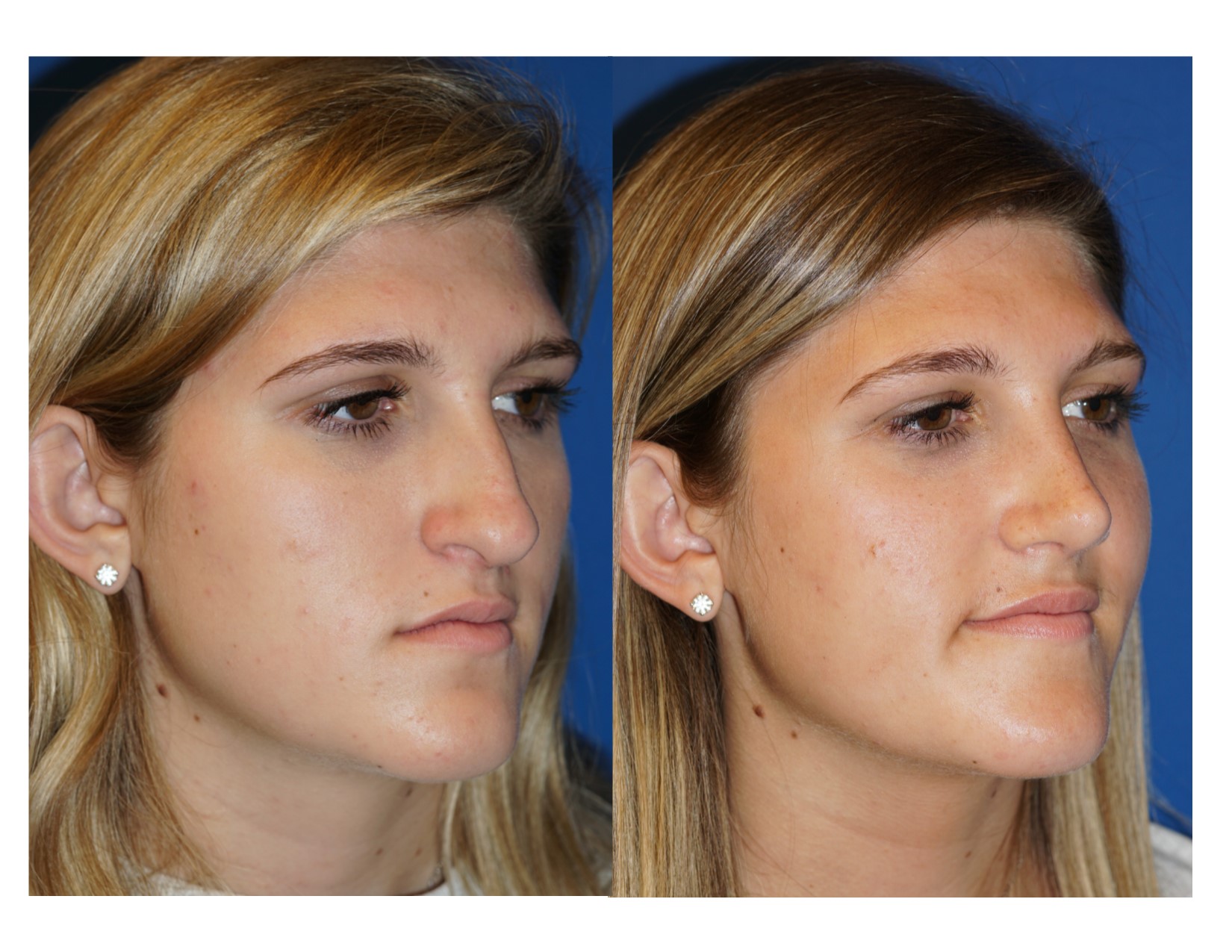 Rhinoplasty 4 Image 4