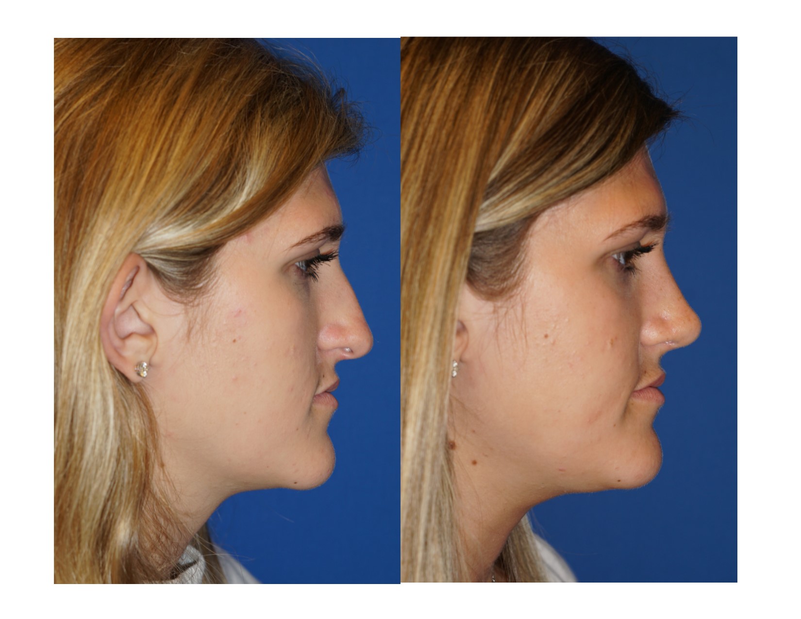 Rhinoplasty 4 Image 5