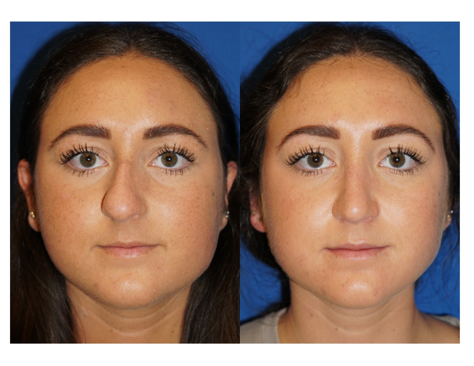 Rhinoplasty 5 Image 1