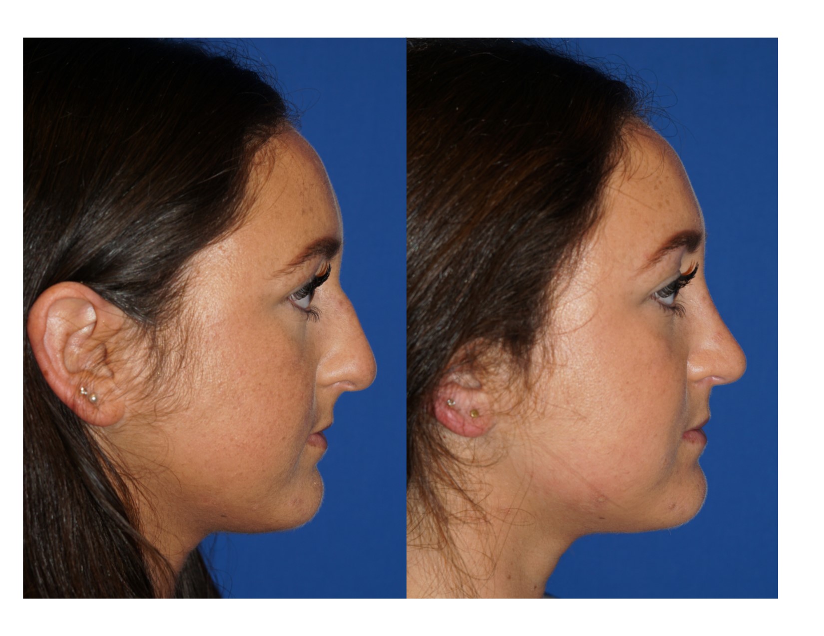 Rhinoplasty 5 Image 2
