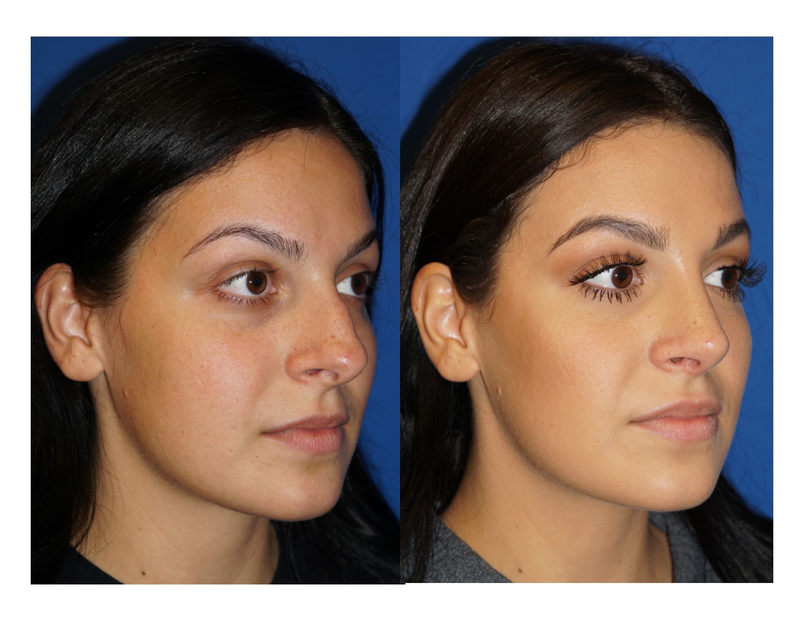 Rhinoplasty 6 Image 4