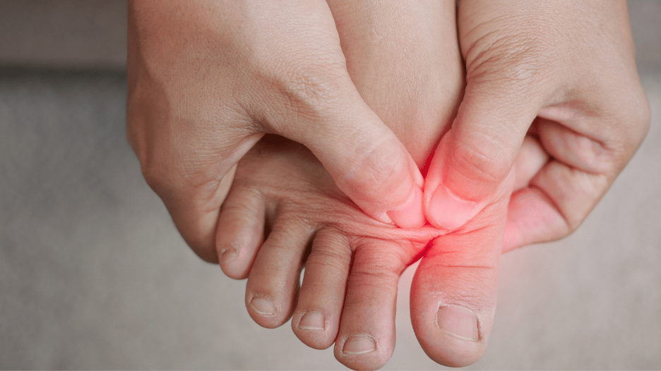 Person pressing on a blister between the toes