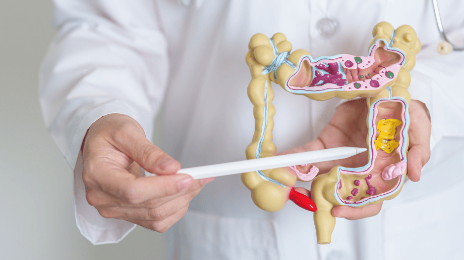 Summit Health gastroenterologist with colon model showing inflammatory bowel disease and colitis symptoms
